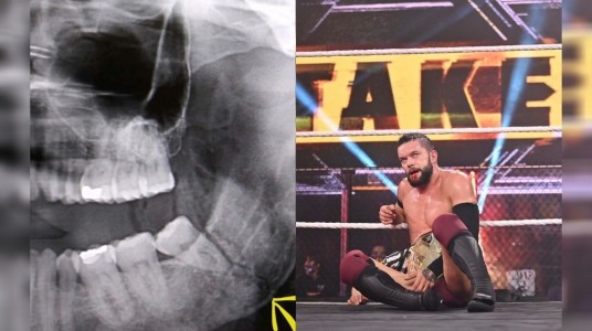 NXT Champion Finn Balor suffered a broken jaw after fight ag...